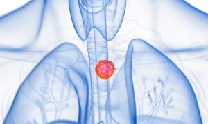 Les tumeurs de l&rsquo;œsophage survivent si elles ont une niche