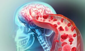 Sept jours après l&rsquo;infection, nous sommes dans la zone des accidents vasculaires cérébraux