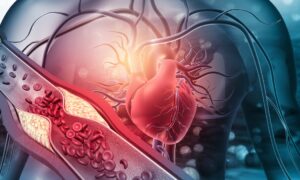 Un nouveau médicament réduit les taux sanguins dangereux de 72 %