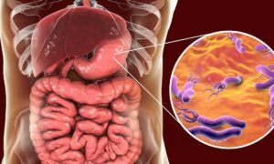Une personne sur trois a des germes gastriques qui peuvent se transformer en cancer