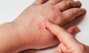 Points rouges sur la main : causes possibles et traitements