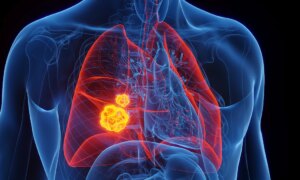 Cancer du poumon chez le pape Léon XIV : « Assez bon pronostic »