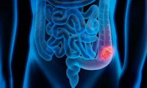 Des selles fines comme un crayon peuvent indiquer un cancer du côlon
